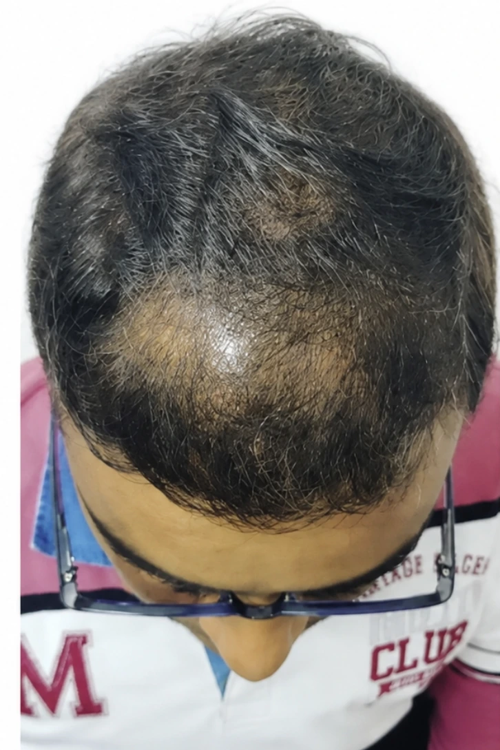 Male Pattern Baldness case 5 before treatment